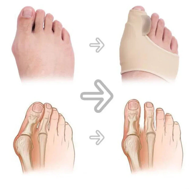 Premium Bunion Corrector Toe Separator - 2Pcs Hallux Valgus Orthotics, Soft Gel Comfort, Adjustable Fabric, Pain Relief for 